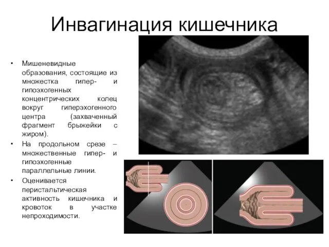 Инвагинация кишечника Мишеневидные образования, состоящие из множестка гипер- и гипоэхогенных концентрических