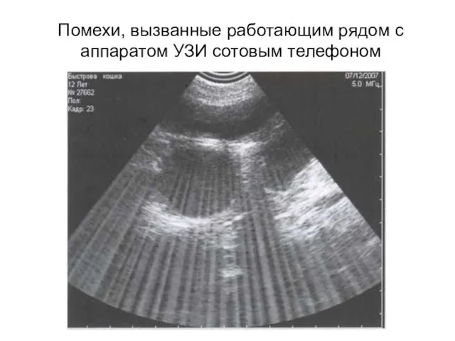 Помехи, вызванные работающим рядом с аппаратом УЗИ сотовым телефоном