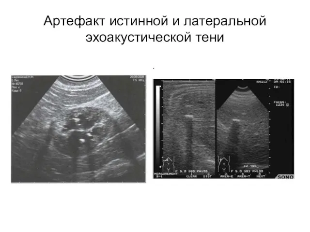 Артефакт истинной и латеральной эхоакустической тени .