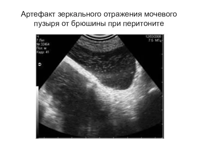 Артефакт зеркального отражения мочевого пузыря от брюшины при перитоните