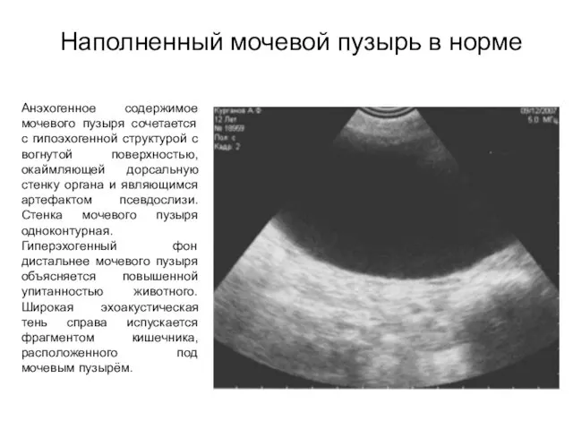 Наполненный мочевой пузырь в норме Анэхогенное содержимое мочевого пузыря сочетается с