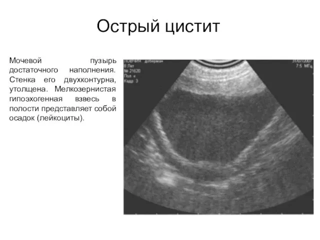 Острый цистит Мочевой пузырь достаточного наполнения. Стенка его двухконтурна, утолщена. Мелкозернистая