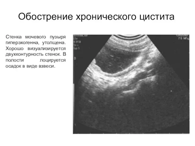 Обострение хронического цистита Стенка мочевого пузыря гиперэхогенна, утолщена. Хорошо визуализируется двухконтурность