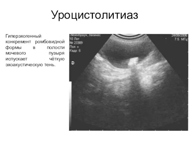 Уроцистолитиаз Гиперэхогенный конкремент ромбовидной формы в полости мочевого пузыря испускает чёткую эхоакустическую тень.