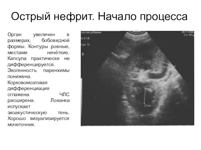 Острый нефрит. Начало процесса Орган увеличен в размерах, бобовидной формы. Контуры