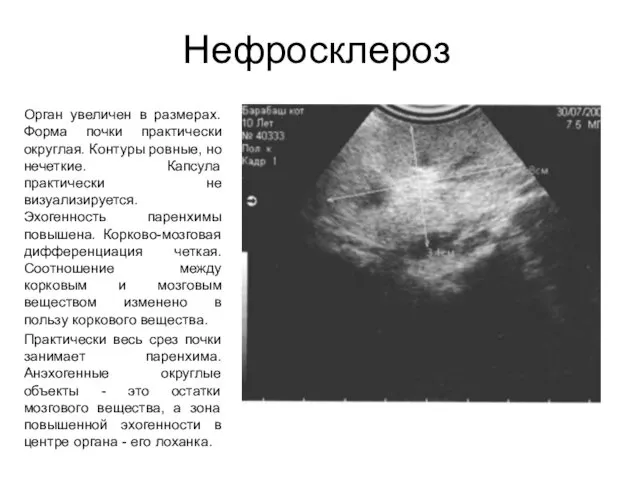 Нефросклероз Орган увеличен в размерах. Форма почки практически округлая. Контуры ровные,