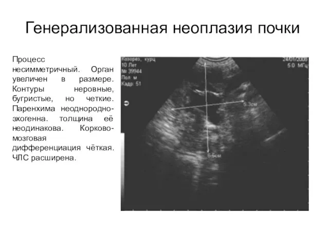 Генерализованная неоплазия почки Процесс несимметричный. Орган увеличен в размере. Контуры неровные,