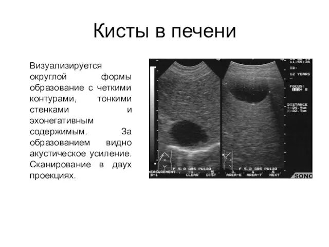 Кисты в печени Визуализируется округлой формы образование с четкими контурами, тонкими