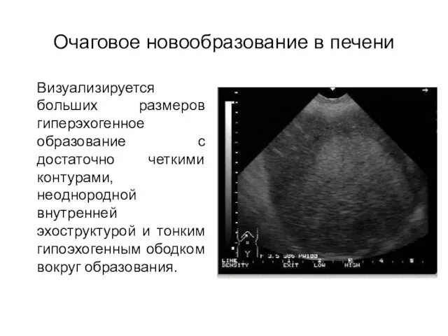 Очаговое новообразование в печени Визуализируется больших размеров гиперэхогенное образование с достаточно