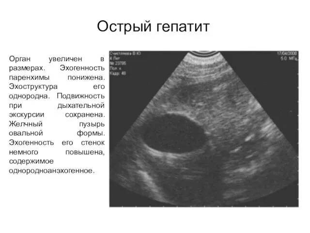 Острый гепатит Орган увеличен в размерах. Эхогенность паренхимы понижена. Эхоструктура его