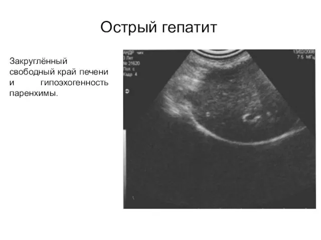 Острый гепатит Закруглённый свободный край печени и гипоэхогенность паренхимы.