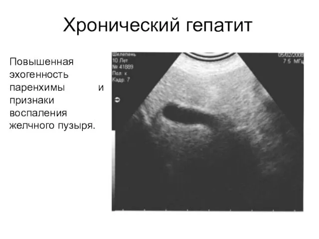 Хронический гепатит Повышенная эхогенность паренхимы и признаки воспаления желчного пузыря.