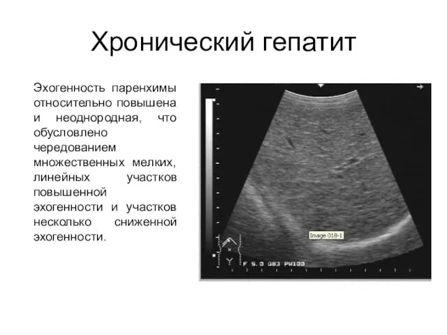 Хронический гепатит Эхогенность паренхимы относительно повышена и неоднородная, что обусловлено чередованием