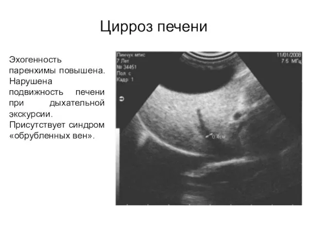 Цирроз печени Эхогенность паренхимы повышена. Нарушена подвижность печени при дыхательной экскурсии. Присутствует синдром «обрубленных вен».