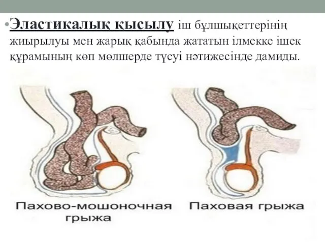 Эластикалық қысылу iш бұлшықеттерiнiң жиырылуы мен жарық қабында жататын iлмекке iшек