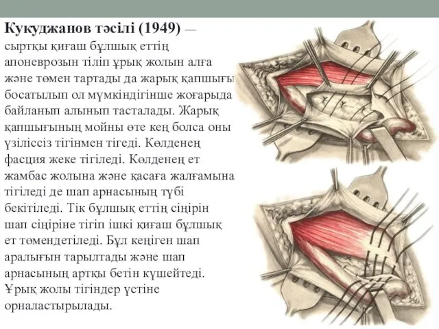 Кукуджанов тәсілі (1949) — сыртқы қиғаш бұлшық еттің апоневрозын тіліп ұрық