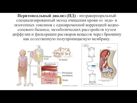 Перитонеальный диализ (ПД) - интракорпоральный специализированный метод очищения крови от эндо-