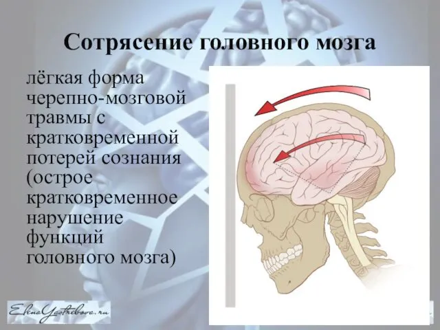 Сотрясение головного мозга лёгкая форма черепно-мозговой травмы с кратковременной потерей сознания