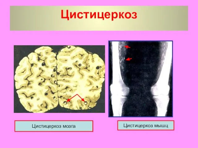 Цистицеркоз Цистицеркоз мозга Цистицеркоз мышц