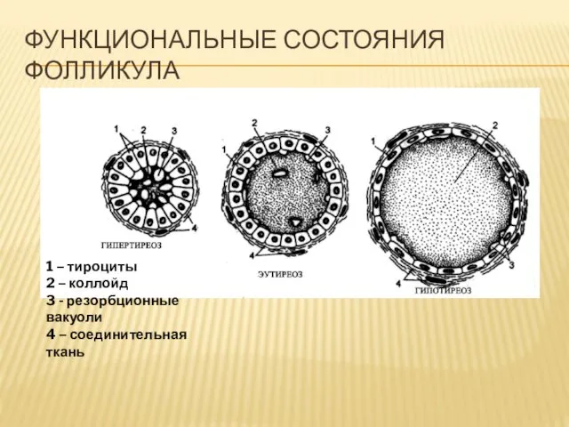 ФУНКЦИОНАЛЬНЫЕ СОСТОЯНИЯ ФОЛЛИКУЛА 1 – тироциты 2 – коллойд 3 -