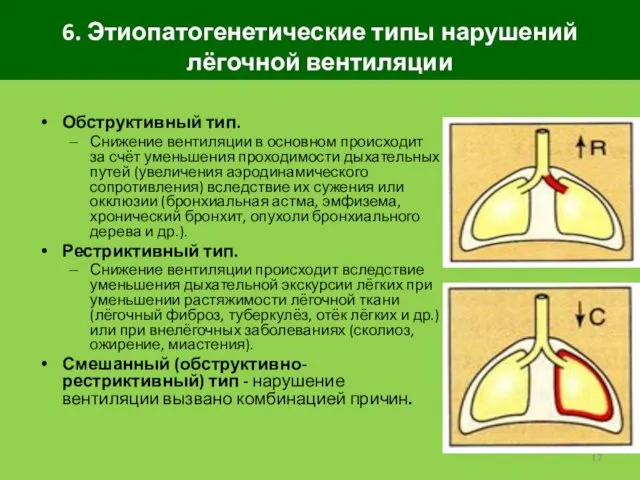 6. Этиопатогенетические типы нарушений лёгочной вентиляции Обструктивный тип. Снижение вентиляции в
