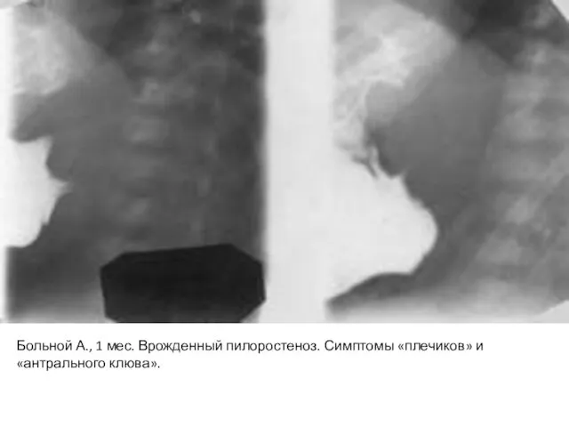 Больной А., 1 мес. Врожденный пилоростеноз. Симптомы «плечиков» и «антрального клюва».