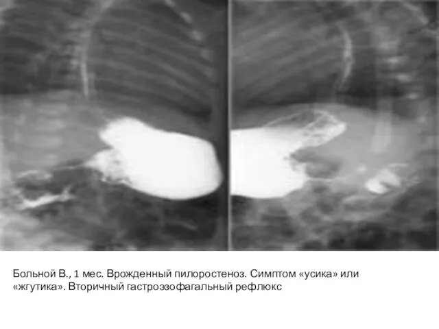 Больной В., 1 мес. Врожденный пилоростеноз. Симптом «усика» или «жгутика». Вторичный гастроэзофагальный рефлюкс