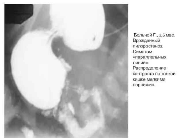 Больной Г., 1,5 мес. Врожденный пилоростеноз. Симптом «параллельных линий». Распределение контраста по тонкой кишке мелкими порциями.