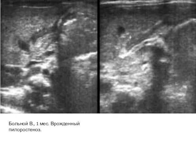 Больной В., 1 мес. Врожденный пилоростеноз.