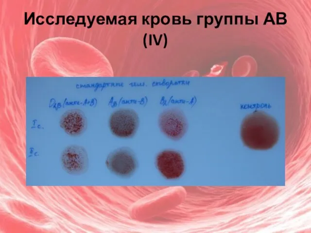 Исследуемая кровь группы АВ(IV)