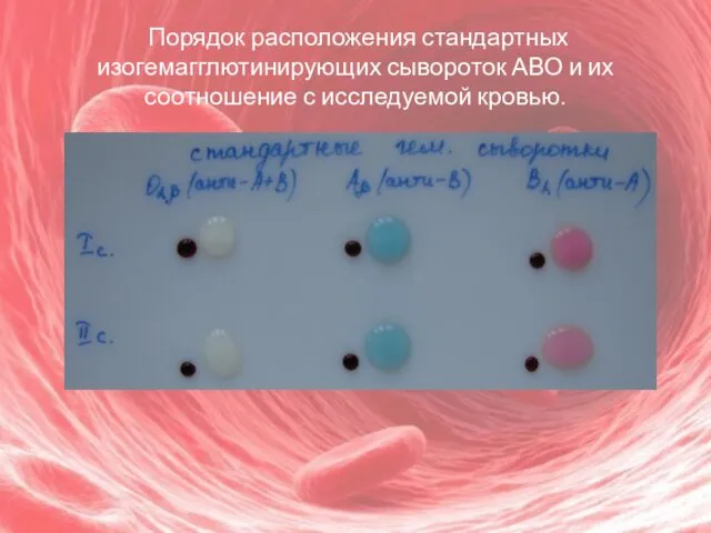 Порядок расположения стандартных изогемагглютинирующих сывороток АВО и их соотношение с исследуемой кровью.