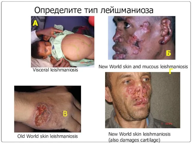 Определите тип лейшманиоза А Б В Г Visceral leishmaniosis Old World