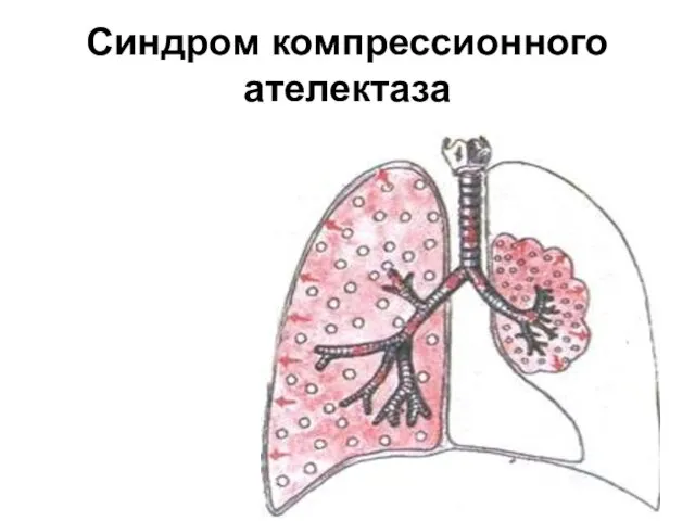 Синдром компрессионного ателектаза