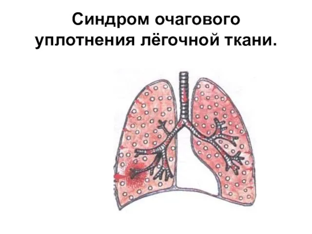 Синдром очагового уплотнения лёгочной ткани.