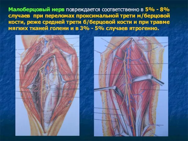 Малоберцовый нерв повреждается соответственно в 5% - 8% случаев при переломах