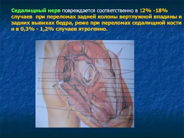 Седалищный нерв повреждается соответственно в 12% -18% случаев при переломах задней