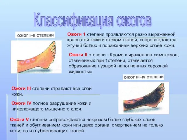 Ожоги 1 степени проявляются резко выраженной краснотой кожи и отеком тканей,