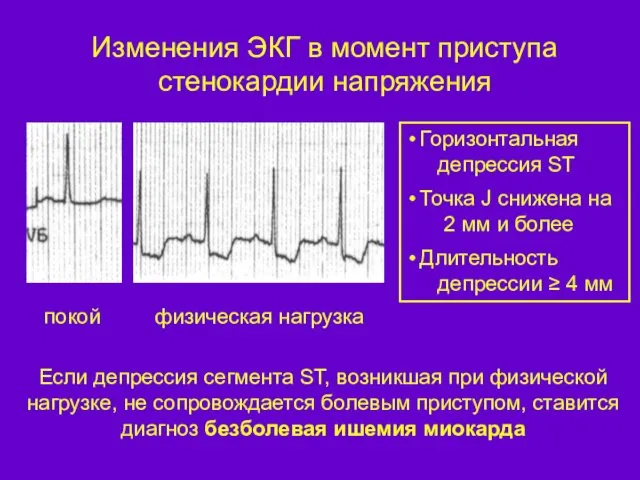 Изменения ЭКГ в момент приступа стенокардии напряжения Если депрессия сегмента ST,