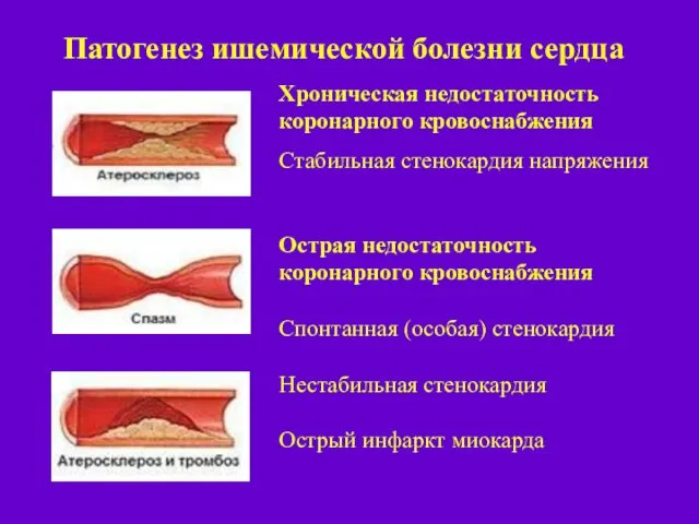 Хроническая недостаточность коронарного кровоснабжения Стабильная стенокардия напряжения Острая недостаточность коронарного кровоснабжения