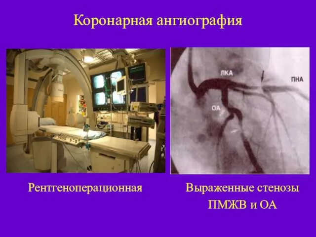 Коронарная ангиография Выраженные стенозы ПМЖВ и ОА Рентгеноперационная