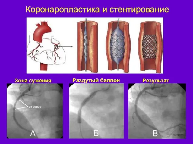 Коронаропластика и стентирование Зона сужения Результат Раздутый баллон