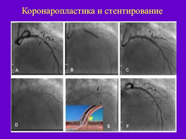 Коронаропластика и стентирование