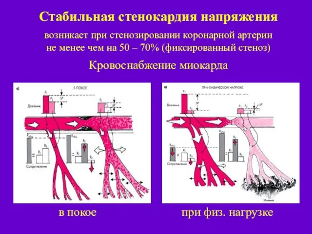 Стабильная стенокардия напряжения возникает при стенозировании коронарной артерии не менее чем