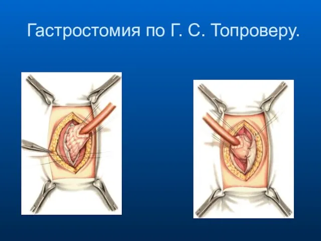 Гастростомия по Г. С. Топроверу.