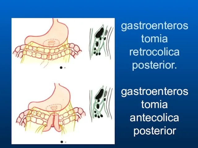 gastroenterostomia retrocolica posterior. gastroenterostomia antecolica posterior