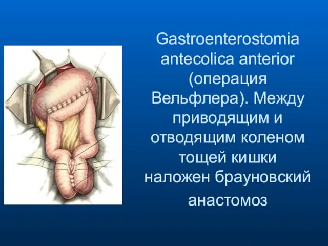 Gastroenterostomia antecolica anterior (операция Вельфлера). Между приводящим и отводящим коленом тощей кишки наложен брауновский анастомоз