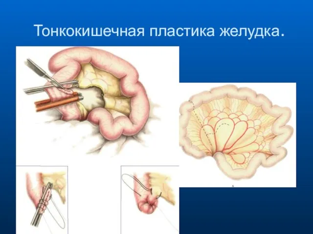 Тонкокишечная пластика желудка.