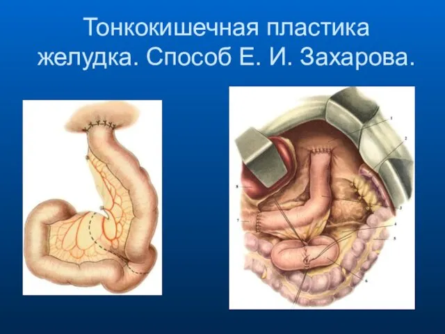 Тонкокишечная пластика желудка. Способ Е. И. Захарова.