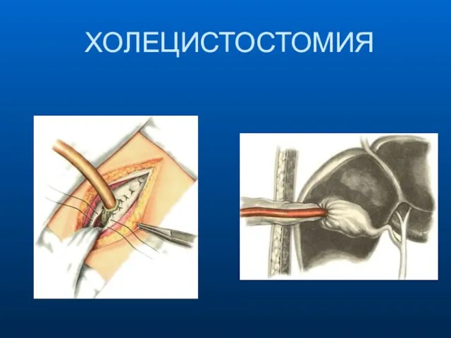 ХОЛЕЦИСТОСТОМИЯ