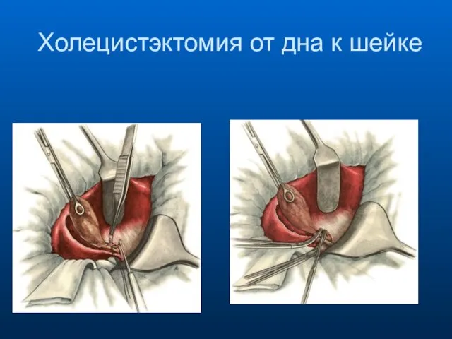 Холецистэктомия от дна к шейке